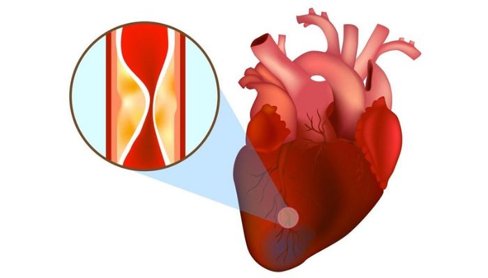 Chẩn đoán và xử lý khi bị nhồi máu cơ tim